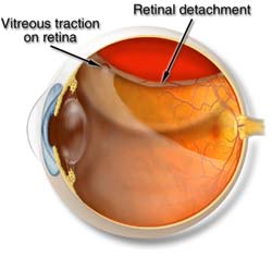 Retinal Detachment